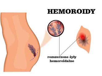 hemoroidy