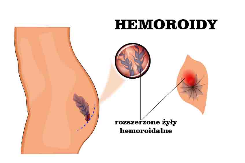 hemoroidy