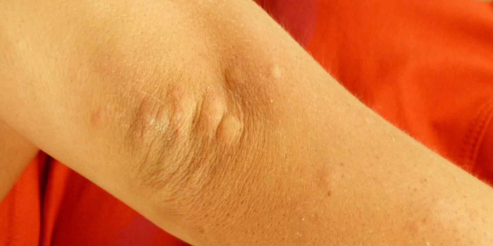 pokrzywka alergiczna