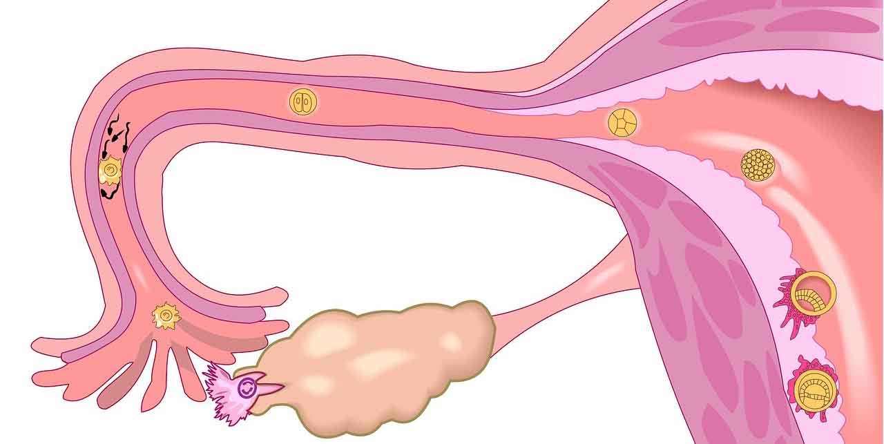zespół Mayera-Rokitansky'ego-Küstera-Hausera
