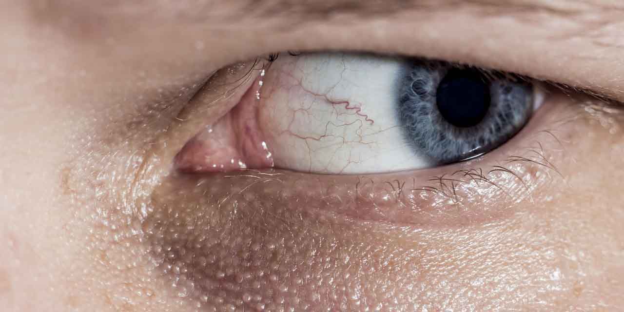 opryszczka narządu wzroku