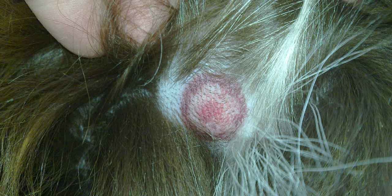 rumień po ukąszeniu kleszcza