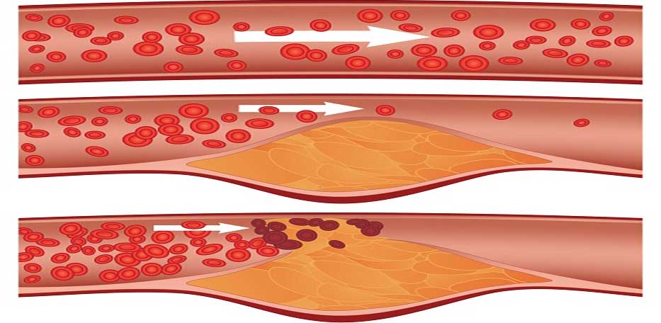 Napój oczyszczający tętnice
