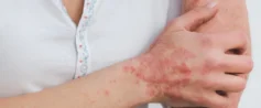 Choroby skóry